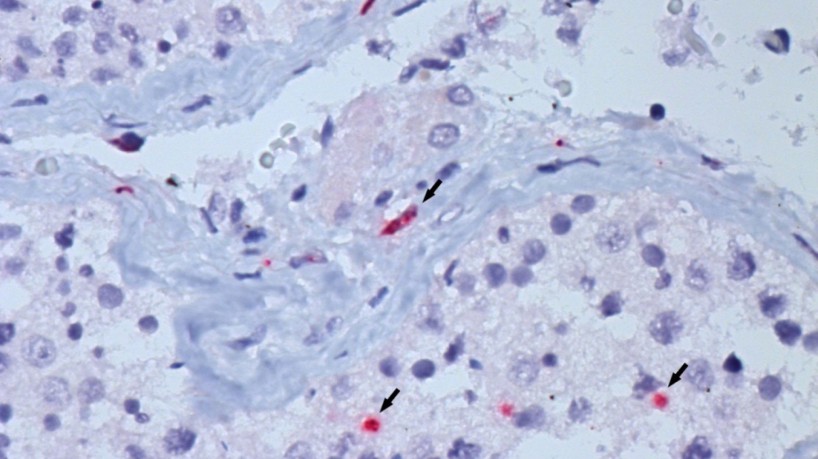  Caso de “flurona” descoberto em Israel não é novidade no Ceará