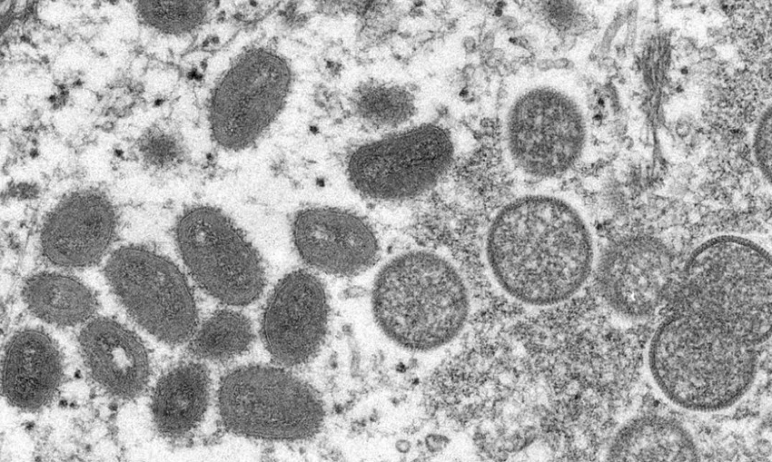  Ministério da Saúde confirma um caso suspeito de varíola dos macacos no Ceará