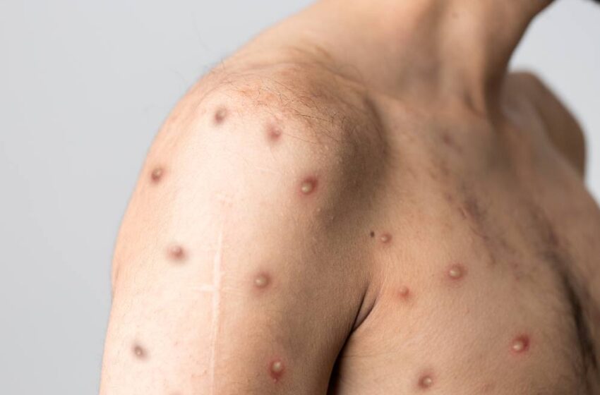  Ceará tem novo caso suspeito de varíola dos macacos