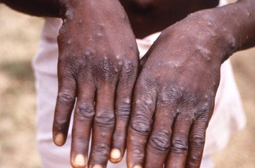  Barbalha monitora casos suspeitos de monkeypox