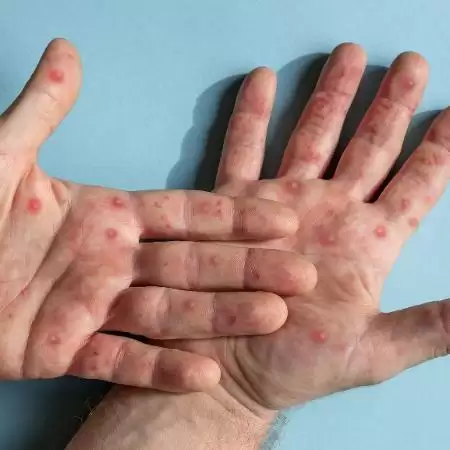  Ceará confirma primeiro caso de mulher com varíola dos macacos; São 60 pacientes infectados.