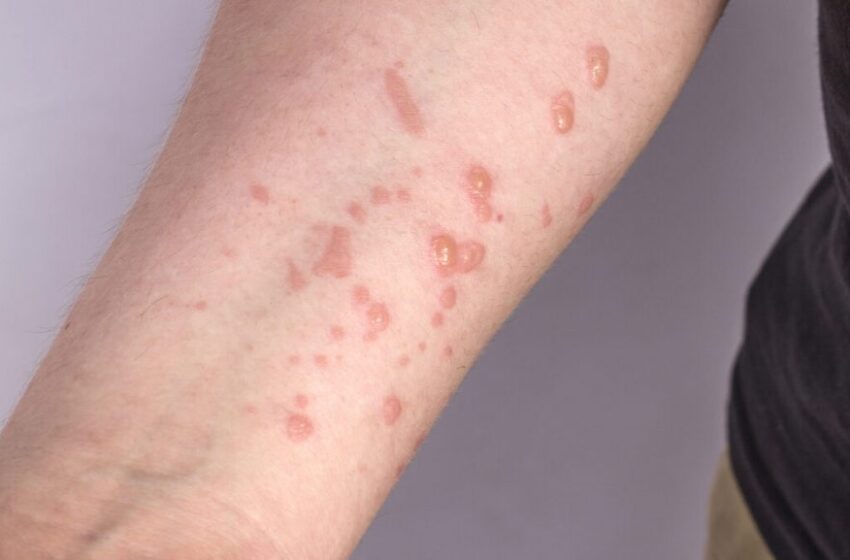  Paciente com vírus da monkeypox morre por complicações de saúde em Crateús.