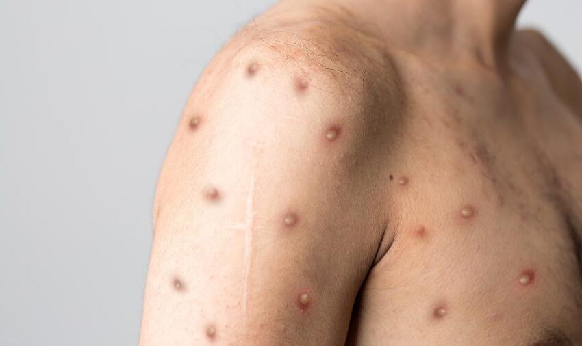 Boletim de Monkeypox de Brejo Santo – CE.