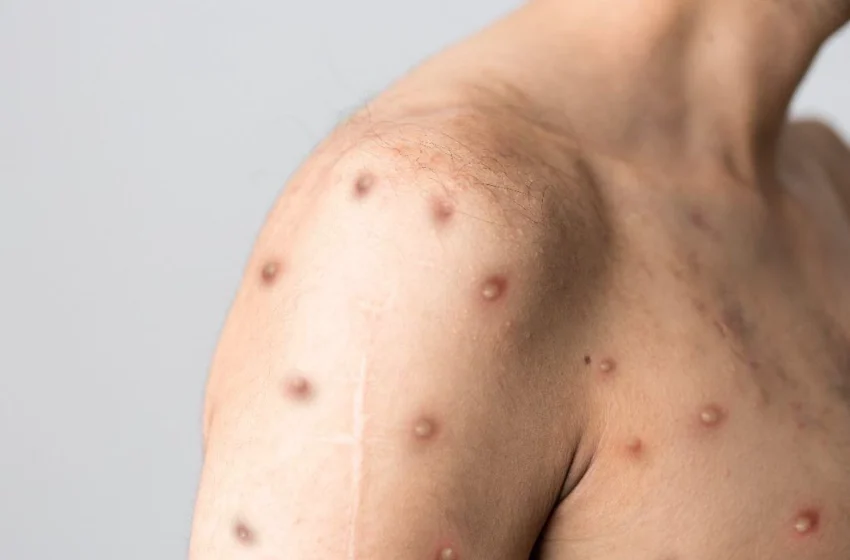  Monkeypox tem quase 600 casos confirmados no Ceará.