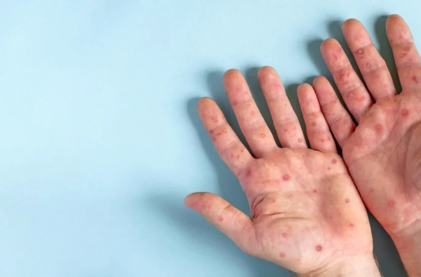  Vacinas contra Mpox chegam ao Estado do Ceará.