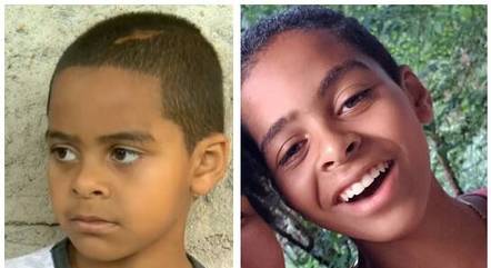  Menino que sofria bullying por queimaduras no corpo ganhou tratamento nos EUA e fez amigos.