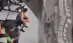  Homem que fraturou coluna em academia volta a sentir movimento das pernas.