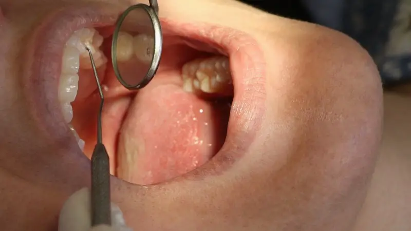  Instituto estima 760 novos casos de câncer de boca no Ceará até o final do ano